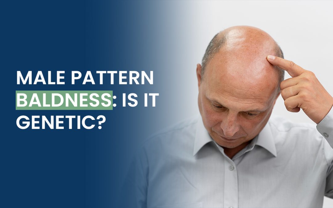 Male Pattern Baldness: Is It Genetic?