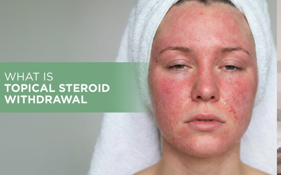 What is Topical Steroid Withdrawal?
