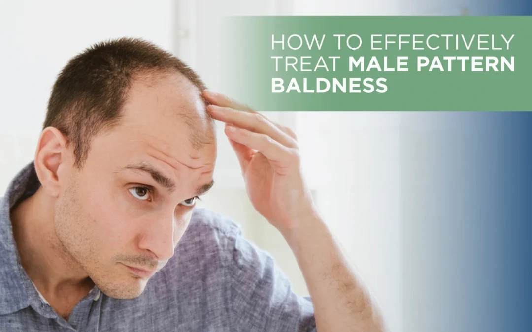 How to Effectively Treat Male Pattern Baldness