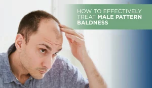 Male pattern baldness treatment guide