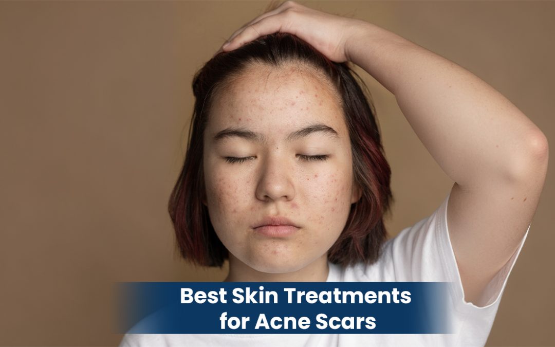 Best Skin Treatments for Acne Scars