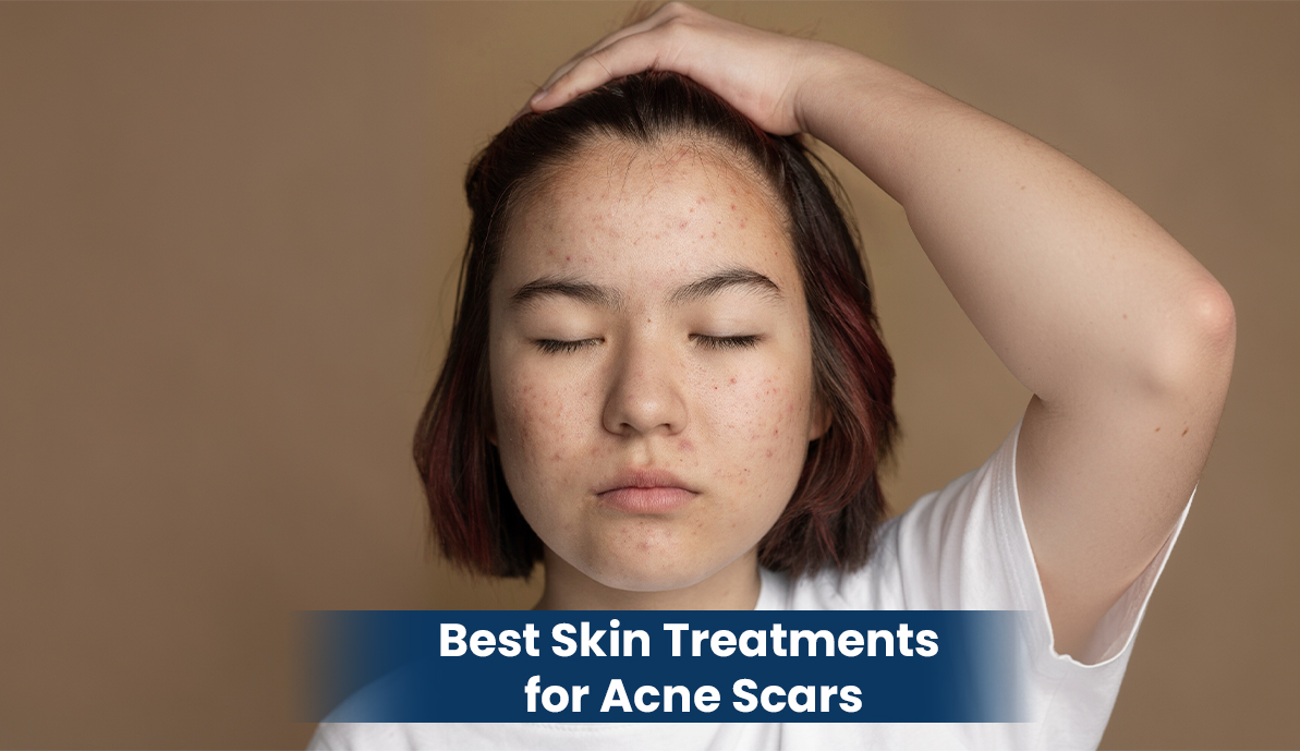 Best Skin Treatments for Acne Scars