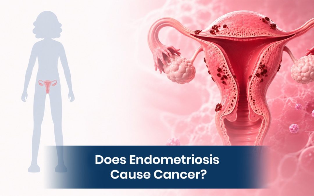 Does Endometriosis Cause Cancer?