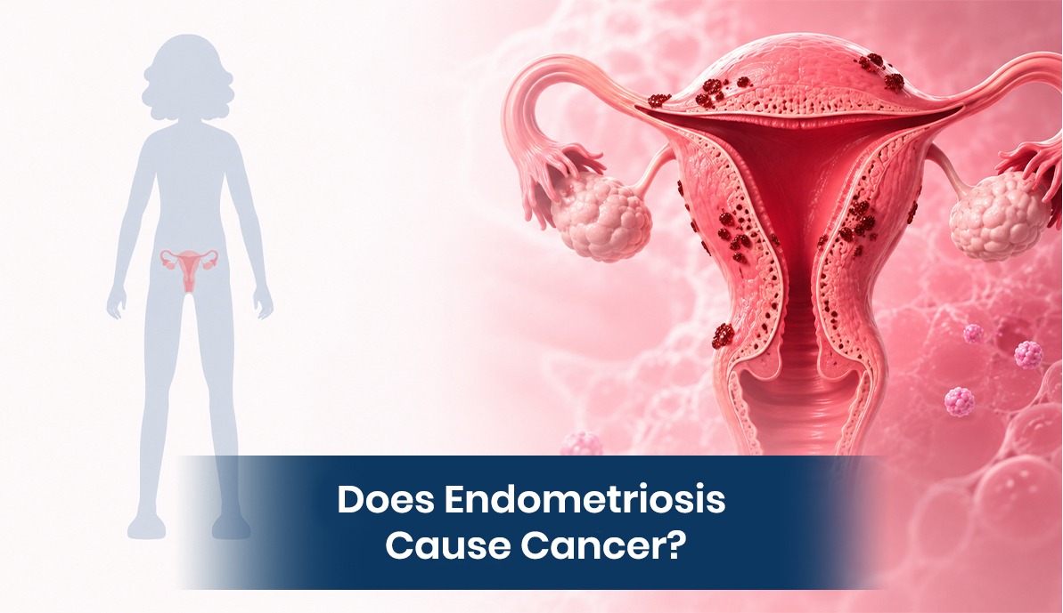Does Endometriosis Cause Cancer