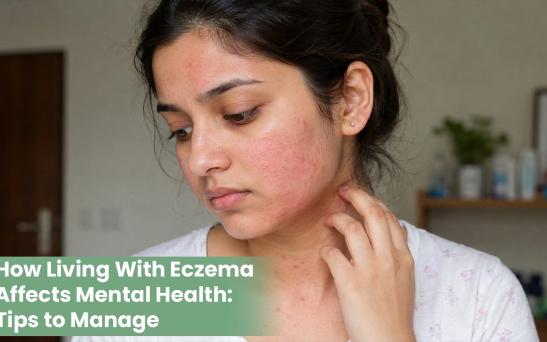 How Living With Eczema Affects Mental Health: Tips to Manage