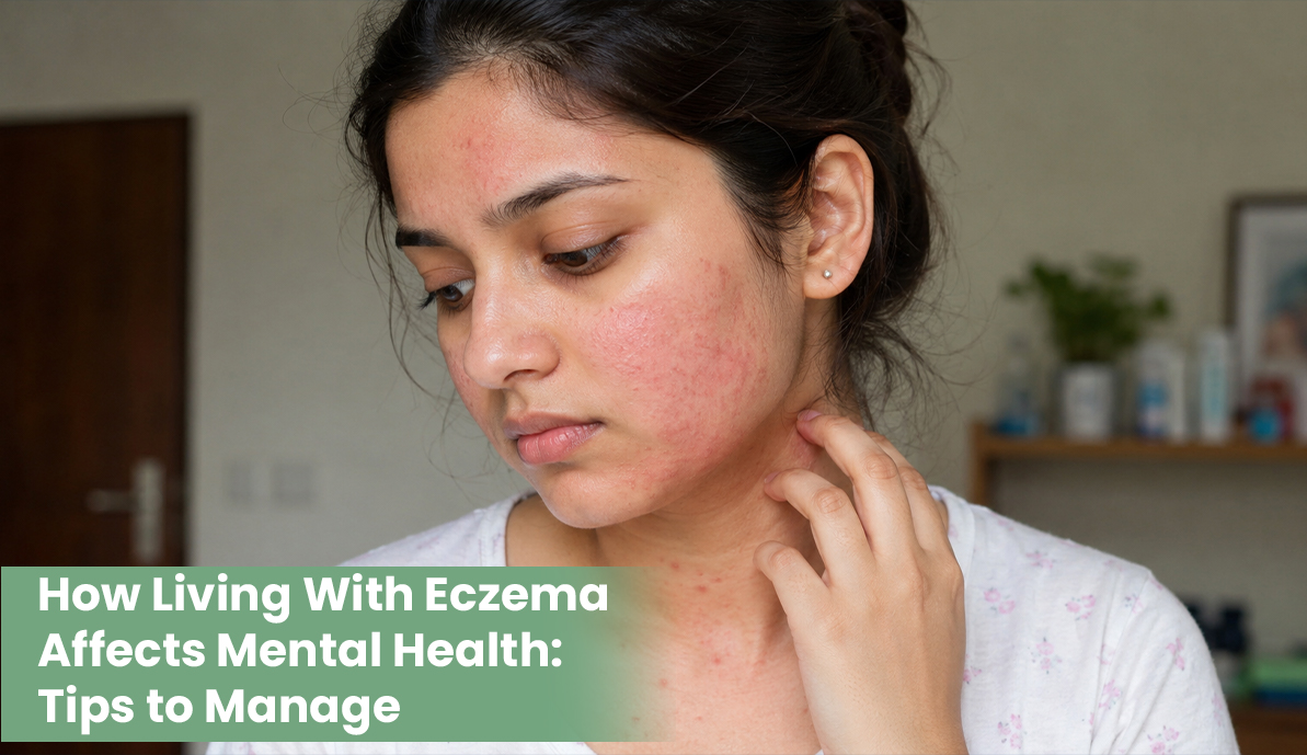 How Living With Eczema Affects Mental Health: Tips to Manage