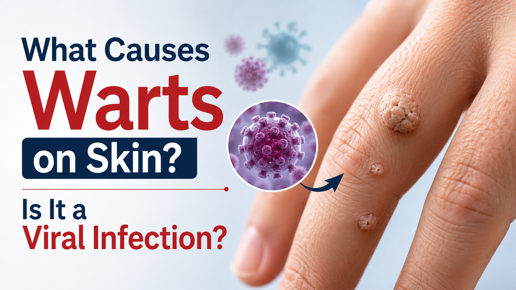 What Causes Warts on Skin? Is It a Viral Infection